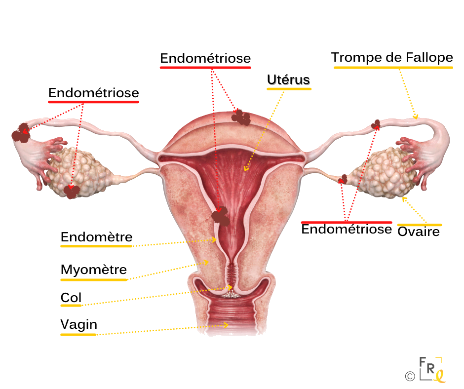 Illustration d'endométriose dans la cavité utérine